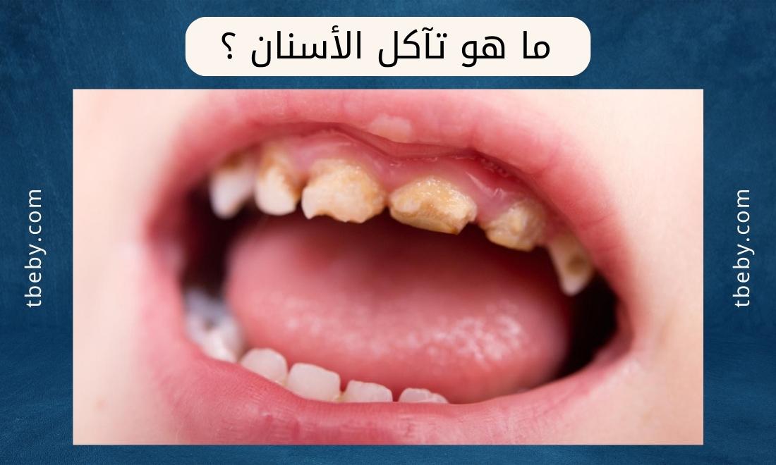 علاج تآكل الأسنان للأطفال