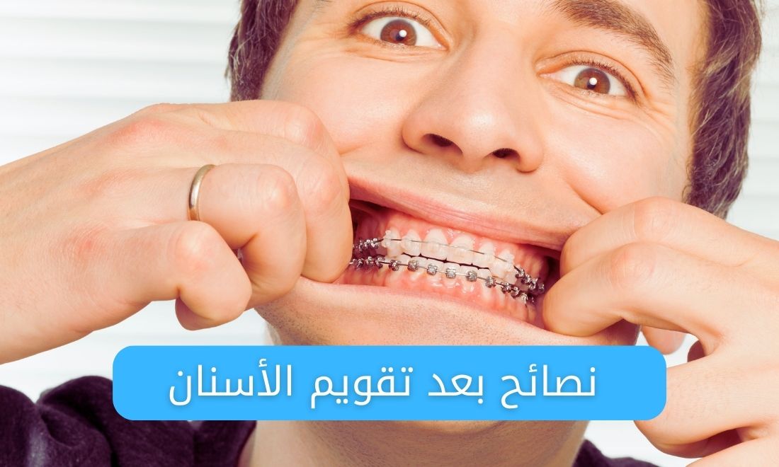 أهم النصائح من أجل الحفاظ على أسنانك خلال فترة التقويم: