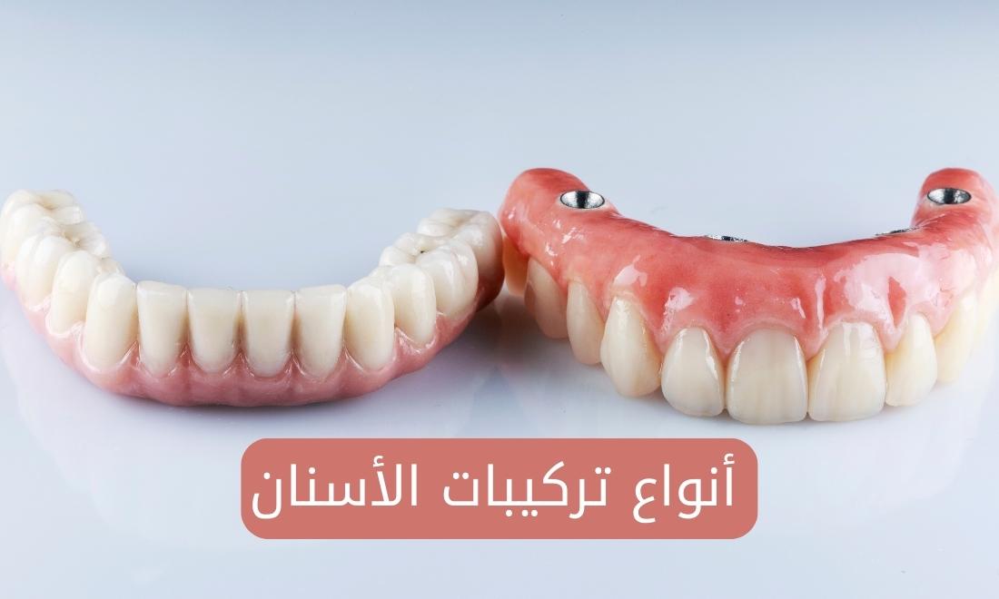 أنواع تركيبات الأسنان وأسعارها