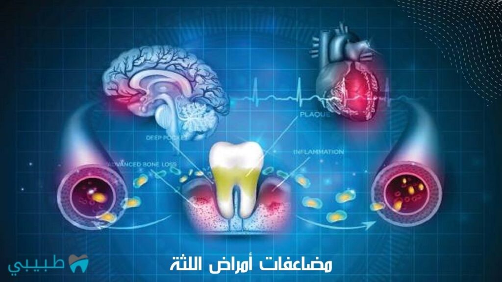 مضاعفات-أمراض-اللثة