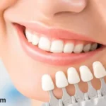 اسعار فينير الاسنان