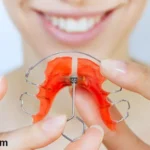 Removable Orthodontic Braces – Advantages, Disadvantages, Prices, and More