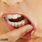 علاج تورم اللثه حول ضرس العقل