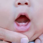 فطريات الفم عند الرضع