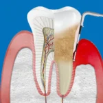 تمويت عصب الضرس بالمنزل