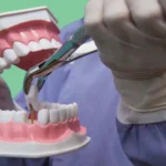 ظهور طبقة بيضاء على اللثة بعد خلع الضرس