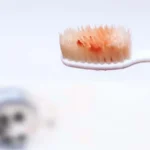 Causes of Gum Bleeding, Treatment, and Tips to Prevent It Permanently