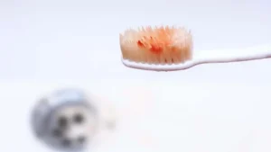 Causes of Gum Bleeding, Treatment, and Tips to Prevent It Permanently