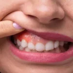 اعراض خراج الاسنان