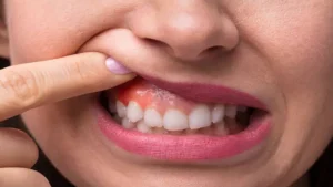 اعراض خراج الاسنان