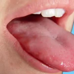 Mouth and Tongue Numbness – Causes, Treatment, and Is It Dangerous? 2026