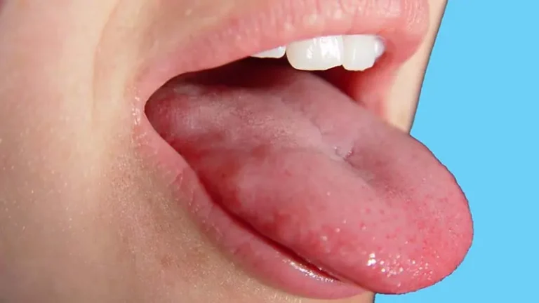 Mouth and Tongue Numbness – Causes, Treatment, and Is It Dangerous? 2026