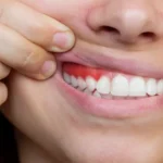 جل لعلاج التهاب اللثة