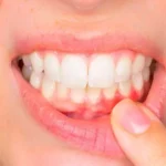 جل لعلاج التهاب اللثه