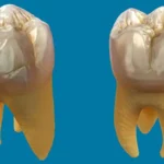علاج التهابات الضرس