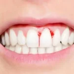 علاج نزيف اللثة