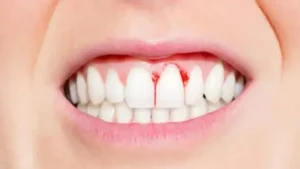 علاج نزيف اللثة