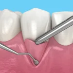 Everything About Gum Contouring: Benefits, Risks, and Costs 2026