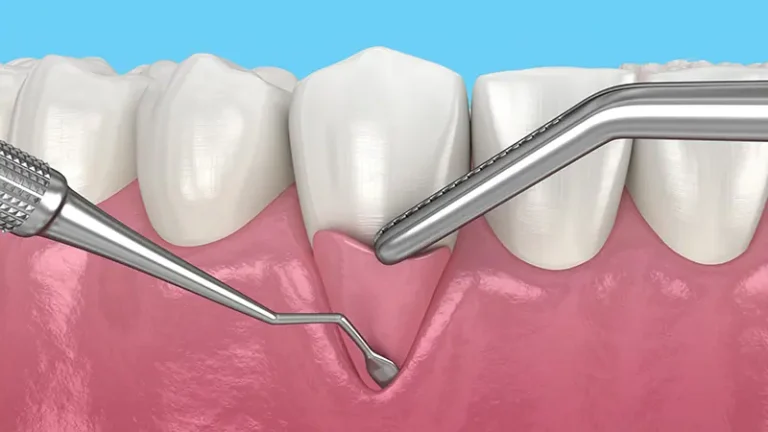 Everything About Gum Contouring: Benefits, Risks, and Costs 2026