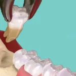 متى تلتئم اللثة بعد خلع الضرس