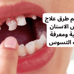 ٤ من أهم طرق علاج تسوس الاسنان