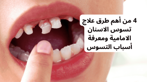 ٤ من أهم طرق علاج تسوس الاسنان