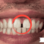 ما الذي يجب فعله بعد خلع الضرس ومتى تلتئم اللثة بعد الخلع؟