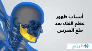 أسباب ظهور عظم الفك بعد خلع الضرس