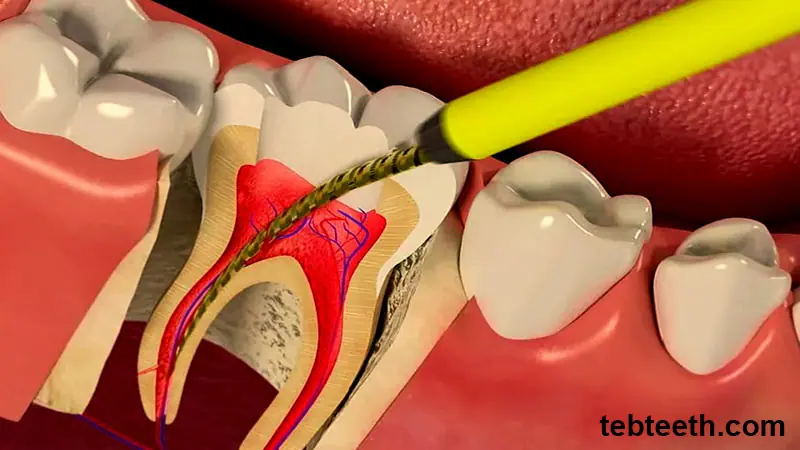 Root Canal Treatment Prices
