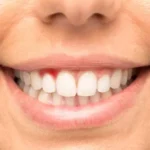 اعراض التهاب اللثة