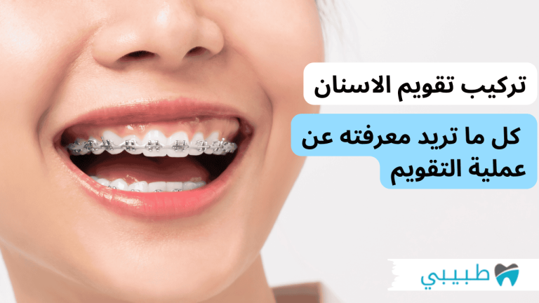 تركيب تقويم الاسنان