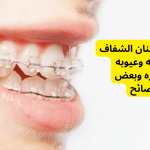 تقويم الاسنان الشفاف