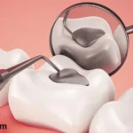 Dental Fillings: Features, Types, Prices, Advantages