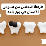 طريقة التخلص من تسوس الأسنان في يوم واحد