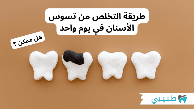 طريقة التخلص من تسوس الأسنان في يوم واحد