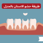 طريقة حشو الاسنان بالمنزل