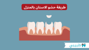 طريقة حشو الاسنان بالمنزل