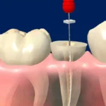 علاج عصب الضرس المكشوف