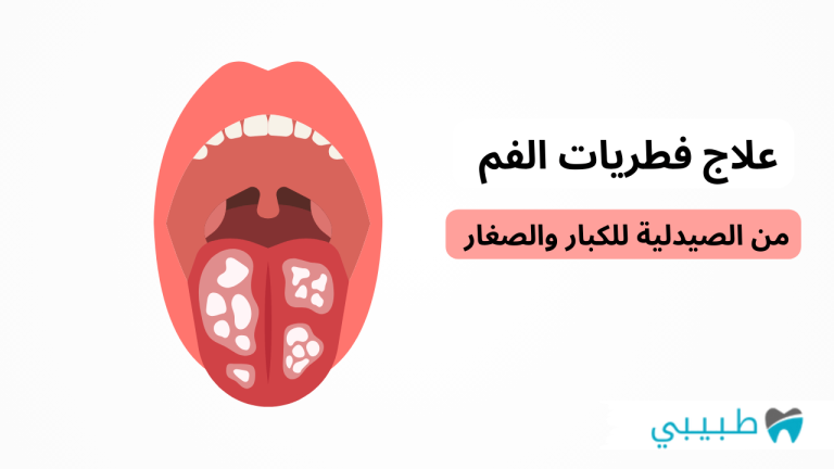علاج فطريات الفم من الصيدلية للكبار وللأطفال