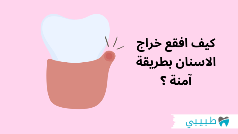 كيف افقع خراج الاسنان بطريقة آمنة، وما هي مدة شفاء الخراج