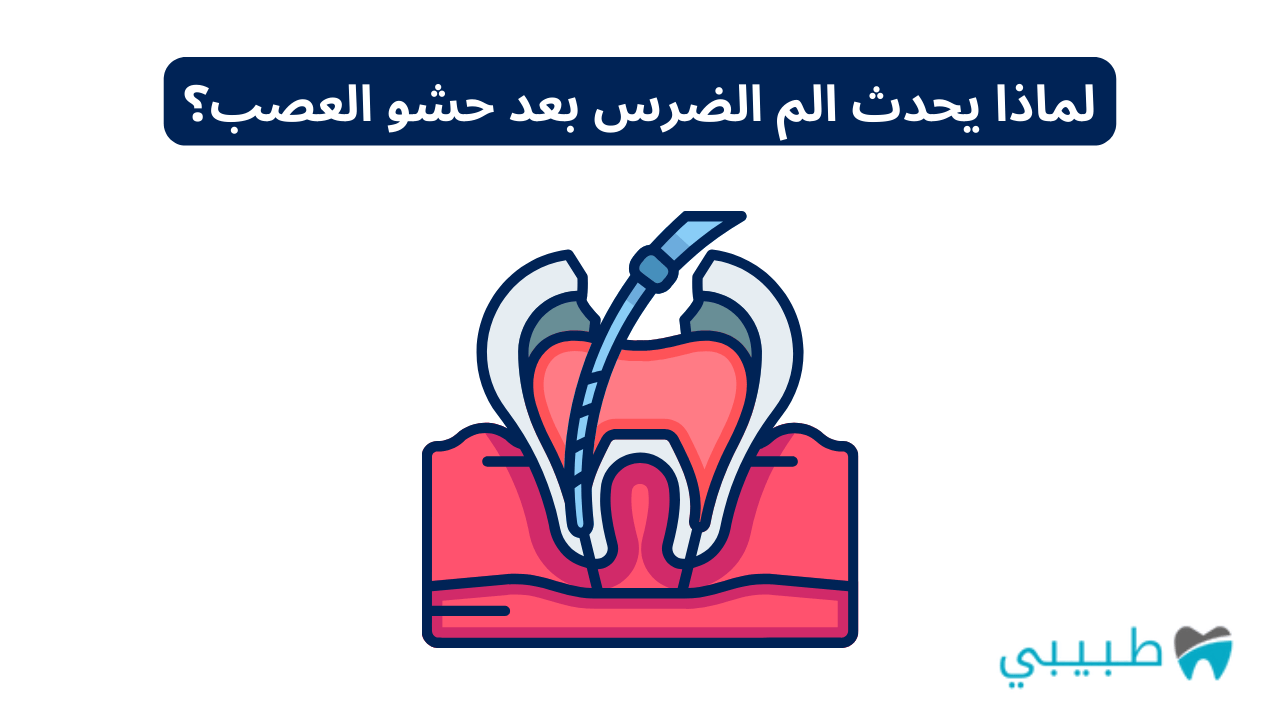 لماذا يحدث الم الضرس بعد حشو العصب؟ وكم يستمر الألم؟