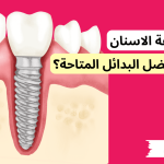 مخاطر زراعة الاسنان