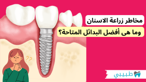 مخاطر زراعة الاسنان