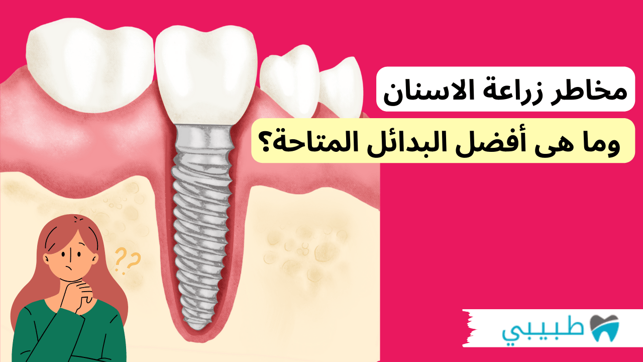 مخاطر زراعة الاسنان