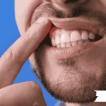 اسباب التهاب اللثة المتكرر