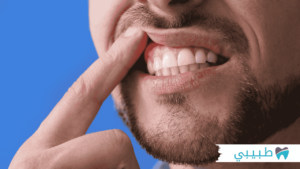 اسباب التهاب اللثة المتكرر