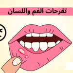 تقرحات الفم واللسان