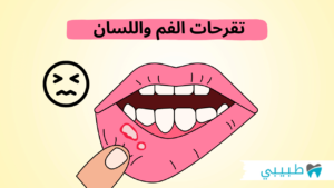 تقرحات الفم واللسان