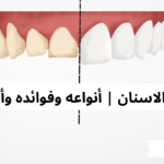 فينير للأسنان