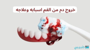 أسباب خروج الدم من الفم